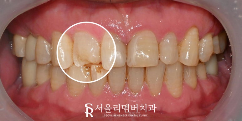 겨울철 넘어짐으로 파절된 앞니 신림 치과 당일 레진 충전 케이스 관련 이미지 1