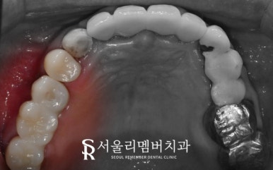 야간 진료 가능한 서울대입구역 치과 에서 퇴근 후에도 임플란트 하실 수 있습니다. 관련 이미지 5