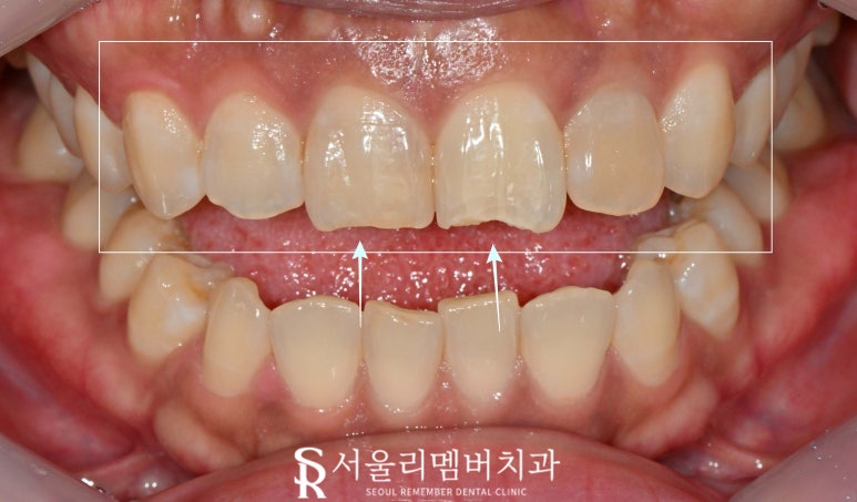 Maxillary Six-Anterior Veneers with RealNate for a Chipped Front Tooth with a Sharp, Rough Edge image 1