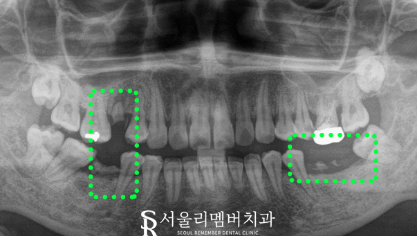 "구강에 빈 곳이 있으면 다른 치아가 우왕좌왕" 서울대입구역 치과 임플란트 수술 후기 관련 이미지 1