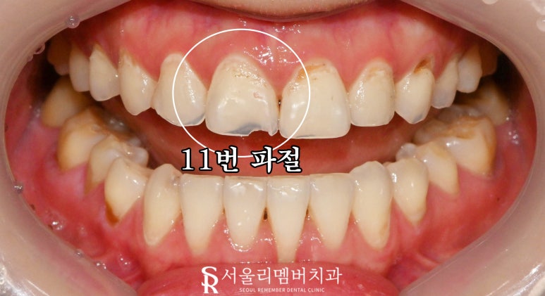 신대방 치과 앞니 끝(절단연) 약간 깨짐? 전치부 파절 레진 당일 치료 및 주의 사항 관련 이미지 3