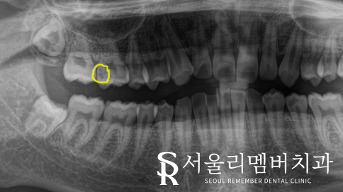 사당동 리멤버 치과 에서 어금니 이시림을 인레이로 개선해 드렸습니다. 관련 이미지 3