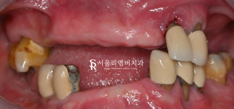 서울대입구역 치과 나에게 맞는 보철은 틀니? 임플란트? 관련 이미지 1