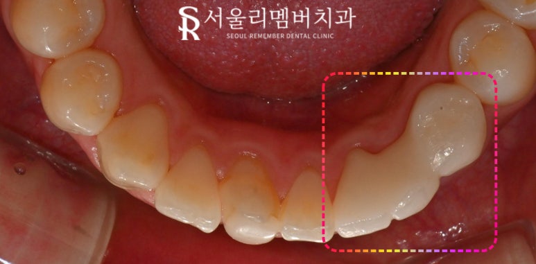서울대입구역 치과 선천적 영구치 결손으로 잔존 유치 발치 후 브릿지 수복 케이스 관련 이미지 4
