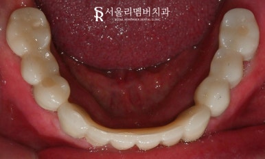 보라매 치과 에서 틀니에서 수면마취 전악 임플란트로 전체 치아 기능 회복 관련 이미지 7