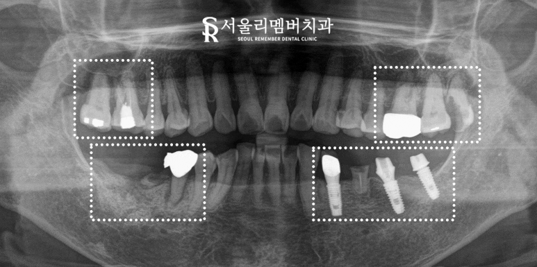 봉천동 치과 상실된 치아 방치하면 안 되는 이유 (feat.임플란트 브릿지 보철치료) 관련 이미지 5