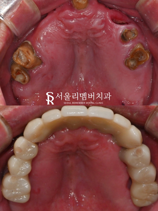 앞니 송곳니 어금니 윗니 전체 임플란트 성공 케이스 "서울대입구역 치과" 관련 이미지 5