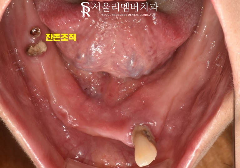텅텅 여기저기 빠져버린 치아들, 이젠 음식을 씹을 수도 없어요.. 어떡하죠? 서울대입구역 리멤버 치과 관련 이미지 3