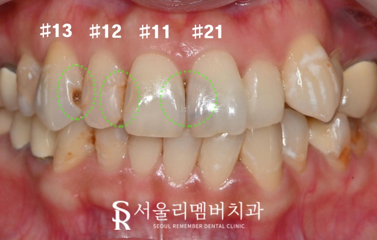 앞니 레진 탈락과 검게 변한 치아, 신림 치과 충치치료 후 크라운으로 개선 관련 이미지 1