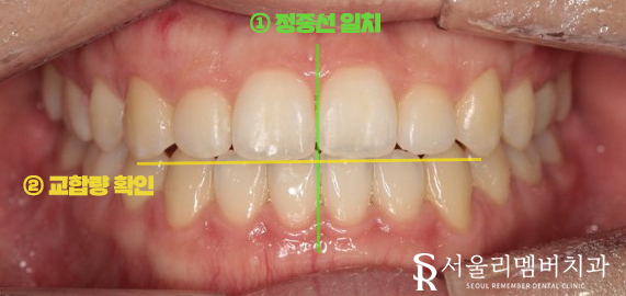 서울대입구역 치과 툭 튀어나온 돌출 때문에 발치교정 진행 관련 이미지 12