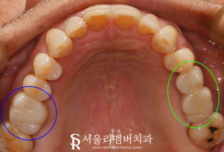 해외 거주하는 한국인, 임플란트 치료는 국내에서 받고 싶다면? 상도동 치과 수술 계획 및 과정 관련 이미지 7