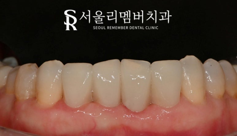 Restore a Natural, Even Smile with No-Prep Realnate! Laminate Veneers for Front Teeth at a Seoul National University Entrance Station Dental Clinic image 4