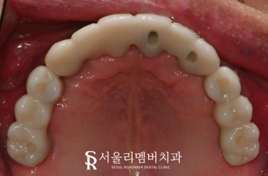 보라매 치과 에서 틀니에서 수면마취 전악 임플란트로 전체 치아 기능 회복 관련 이미지 6