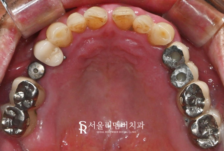 임플란트 및 크라운 으로 구강 환경 개선하는 방법 - 서울대입구역 치과 관련 이미지 2