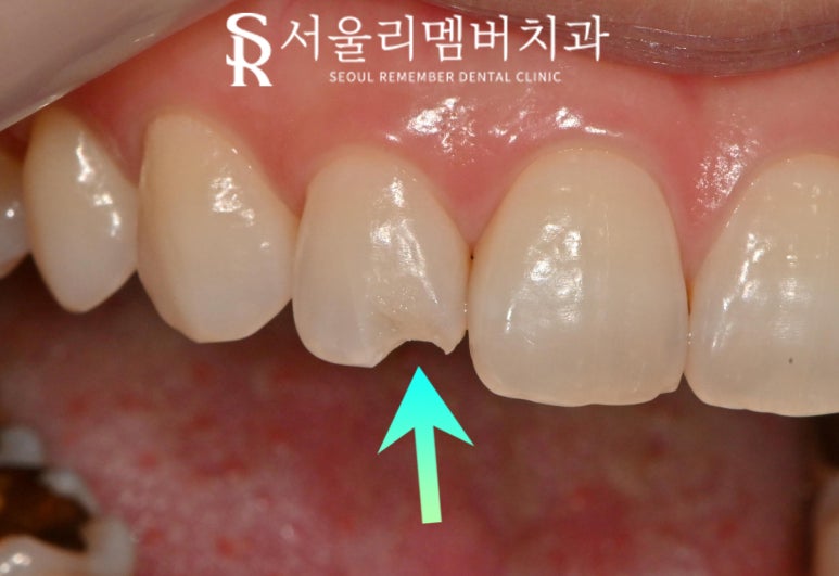 "빠각" 소리와 함께 앞니 절단연 파절 되었다면? 서울대입구역 치과 레진 당일 치료 관련 이미지 1
