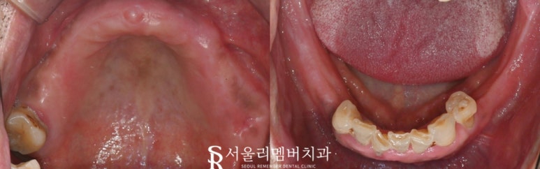 사당 치과, 틀니 대신 전체 임플란트로 새로운 구강 환경 되찾아 드린 사례 관련 이미지 3