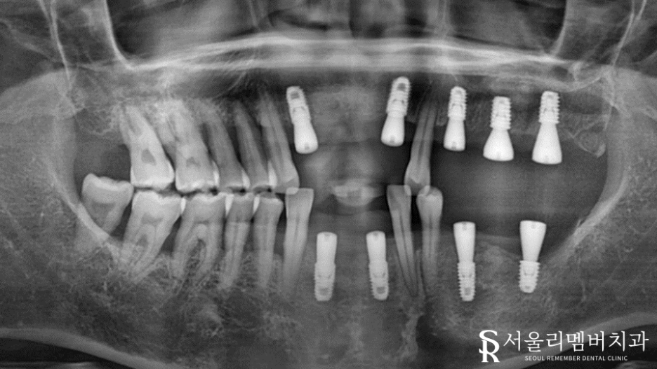 치석이 발치로 이어질 수 있다는 말, 사실일까요?! 봉천동 서울 리멤버 치과 관련 이미지 9