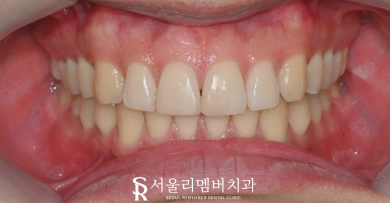 서울대입구역 치과 외상으로 깨진 앞니 당일 레진 치료 후기 관련 이미지 2