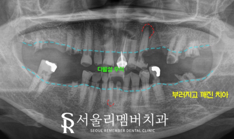 서울대입구역 치과 에서 수면(의식하진정)요법 동반한 전체 임플란트 식립 관련 이미지 1