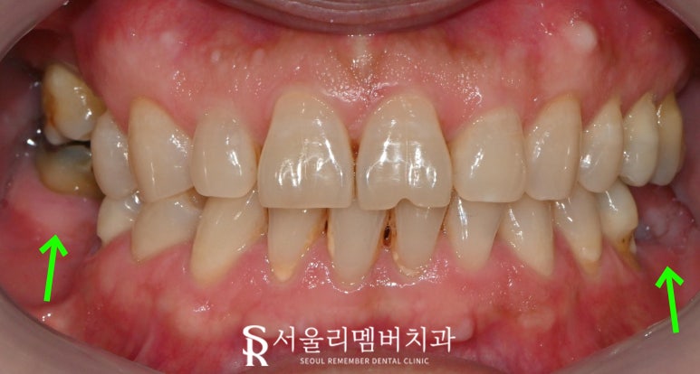 "이제 밥 먹는 것도 문제없어요!" 낙성대 치과 임플란트 로 새로운 구강 환경 찾아 드린 사례 관련 이미지 3