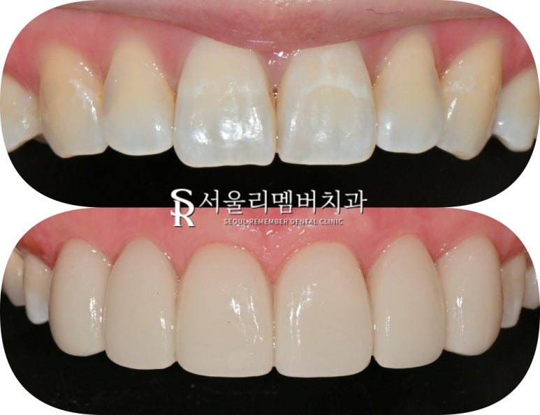 신림역 치과 상악 6전치 리얼네이트 초기 충치 화이트스팟 반점치 라미네이트로 우식 제거 후 보철 수복 과정 관련 이미지 4
