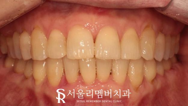 40대 교정 지금 시작해도 늦지 않을까요? 서울대입구역 치과 관련 이미지 10