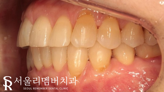 40대 교정 지금 시작해도 늦지 않을까요? 서울대입구역 치과 관련 이미지 12