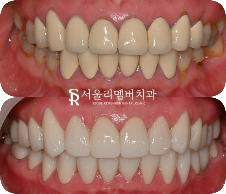 예쁜 미소를 되찾는 순간 낙성대 치과 전악 보철을 통한 치아 심미성 회복의 놀라운 변화 관련 이미지 4