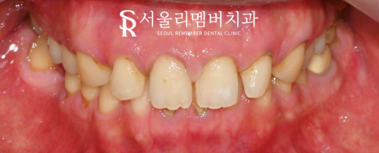 앞니 치료, 이제는 자연스러움이 답이다! 봉천동 치과 진짜 같은 라미네이트 "리얼네이트" 관련 이미지 5