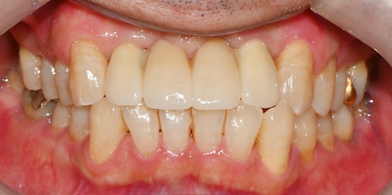보라매 치과 삐뚤어진 교합 불량 앞니, 임플란트로 가지런하게 만들어드린 사례 관련 이미지 6