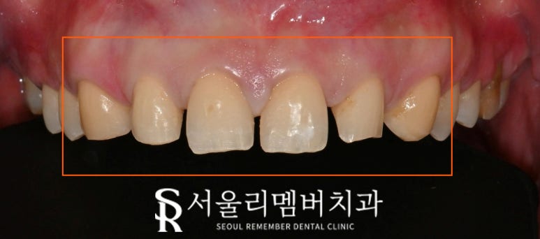 앞니 치료, 이제는 자연스러움이 답이다! 봉천동 치과 진짜 같은 라미네이트 "리얼네이트" 관련 이미지 2