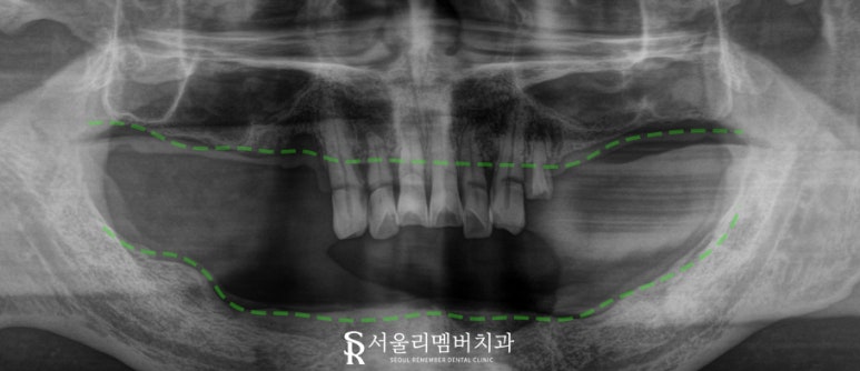 서울대입구역 양심 치과, 최소 비용으로 전체 임플란트 수술 관련 이미지 3