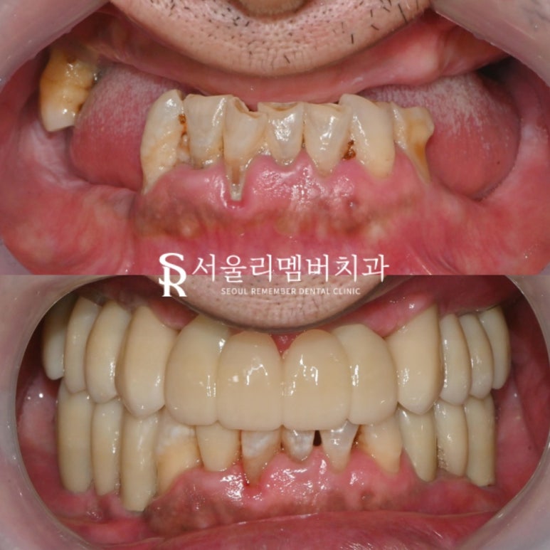 사당 치과, 틀니 대신 전체 임플란트로 새로운 구강 환경 되찾아 드린 사례 관련 이미지 7