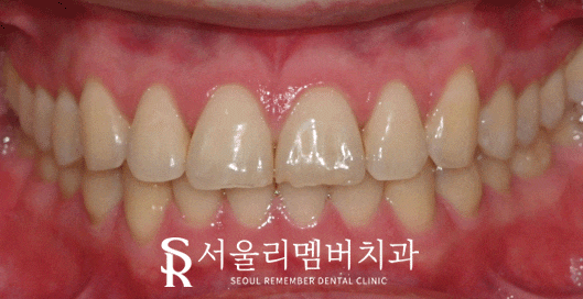 앞니 끝 깨짐 치료, 낙성대 치과 티 안 나는 레진으로 수복하기 관련 이미지 1