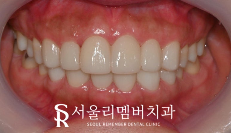 낙성대 치과 앞니 틀어짐 하악 전치 측절치 결손 라미네이트로 공간 닫기 성공 관련 이미지 9