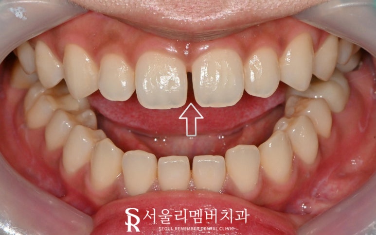 앞니 벌어짐, 레진 말고 라미네이트로 사이 틈새 자연스럽게 채우자 서울대입구 치과 상악 전치부 리얼네이트 케이스 관련 이미지 2