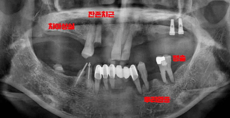 금방이라도 빠져버릴 것 같은 치아들, 전체임플란트 식립으로 개선했던 이야기. 이수역 서울 리멤버 치과 관련 이미지 4