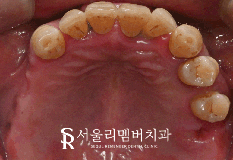 서울대입구역 치과 "부분틀니에서 임플란트로" 바꿔서 전악 개선해 드린 증례 관련 이미지 7