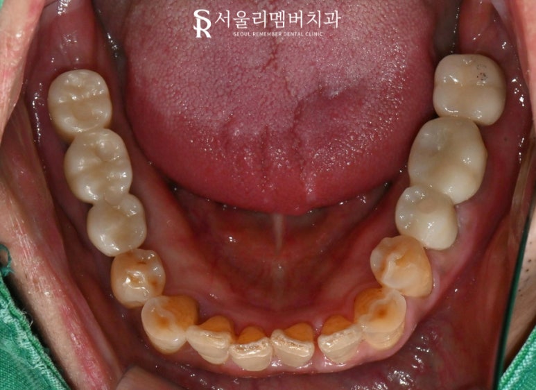 임플란트 잘하는 서울대입구역 치과 , 수면치료로 편안한 진료과정 관련 이미지 3
