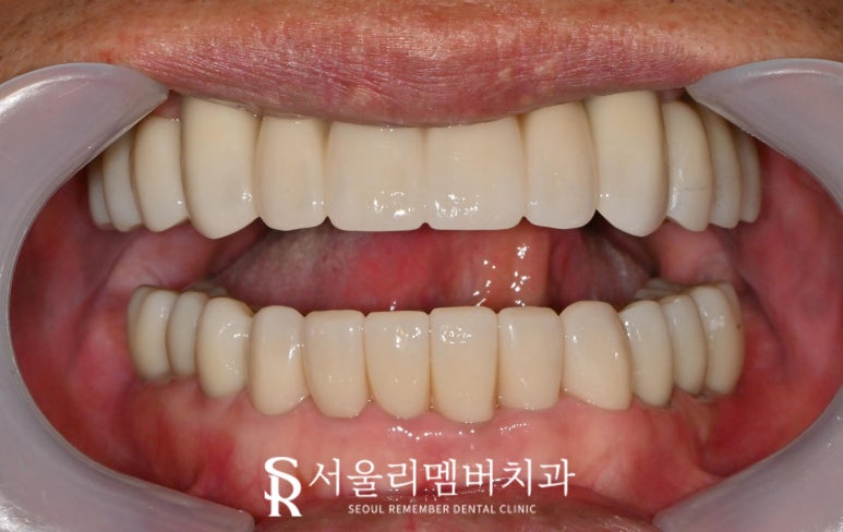 사당 치과 하악 전치 신경치료 브릿지로 살리고 나머지 임플란트로 재건한 전악 증례 관련 이미지 12