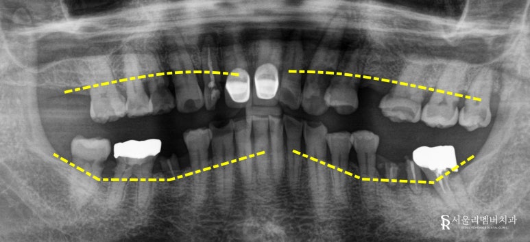 낙성대 치과 다수 상실된 치아 가이드 임플란트 식립으로 정확하고 튼튼한 치료 후기 관련 이미지 2