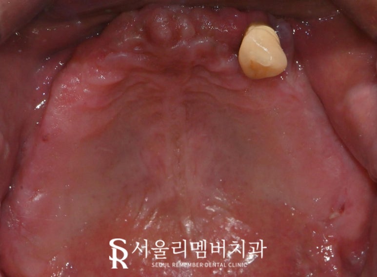 신대방 치과 에서 전악 수면마취 임플란트 수술로 전체 치아 회복시켜드렸습니다. 관련 이미지 3