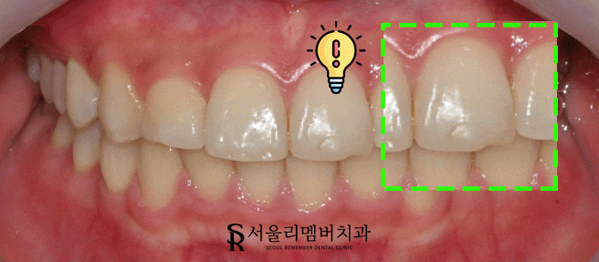 낙성대역 치과 앞니가 깨졌는데 당일 치료 가능할까요? 관련 이미지 2