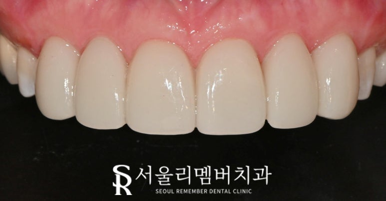 신림역 치과 상악 6전치 리얼네이트 초기 충치 화이트스팟 반점치 라미네이트로 우식 제거 후 보철 수복 과정 관련 이미지 7