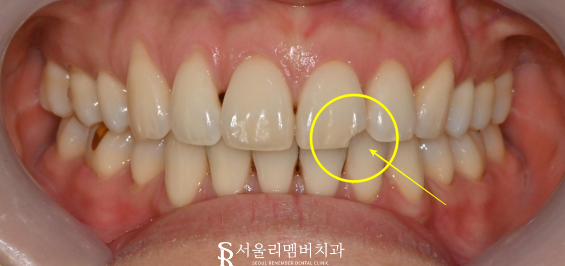 운동하다가 앞니 부러짐, 보라매 치과 에서 레진 치료 과정 관련 이미지 1