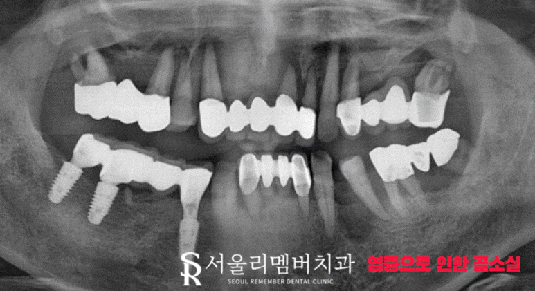 전에 씌워놨던 크라운에서 통증이 느껴져요.. 도대체 왜 그런 거죠? 서울대입구역 서울 리멤버 치과 관련 이미지 4