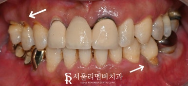 한 번에 많은 치아 치료해야 된다면? 사당역 치과 수면 임플란트 로 편안하게 관련 이미지 4