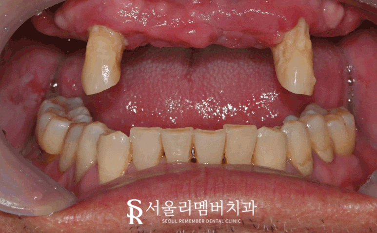 치아가 없을 땐? 서울대입구역 치과 에서 부기 통증 없는 최소절개 전체 디지털 임플란트 치료 관련 이미지 1