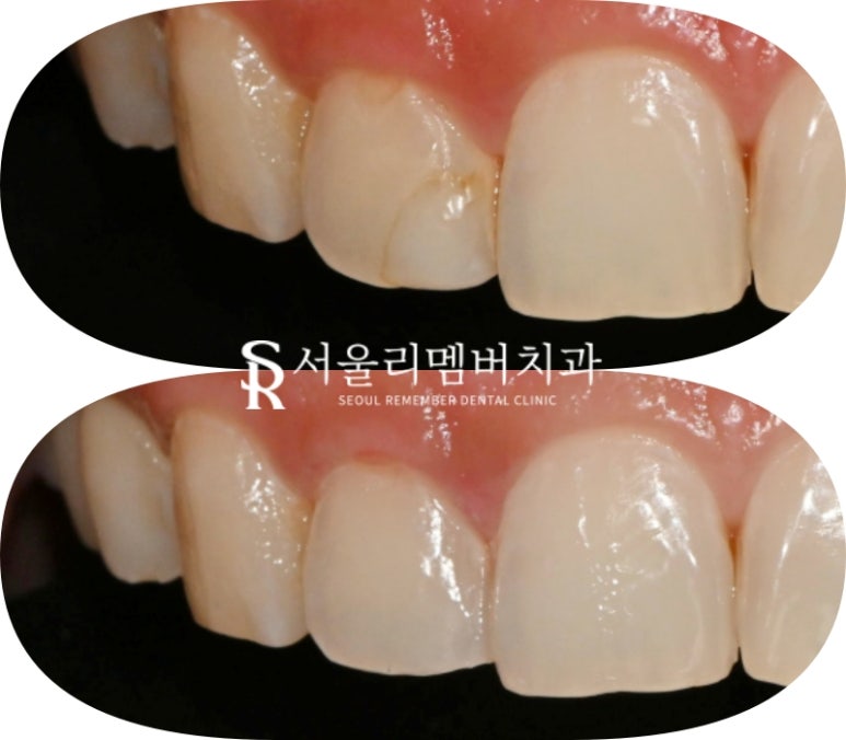 상도동 치과 충치나 치아 깨짐 해결 원탑 레진의 한계는? 주의 사항 및 재치료 방법 관련 이미지 3
