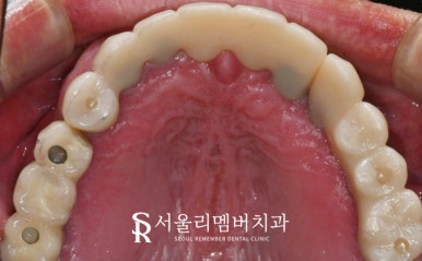 고난도 수술, 서울대입구역 임플란트 치과 에서 치료해야 되는 이유는? 관련 이미지 6